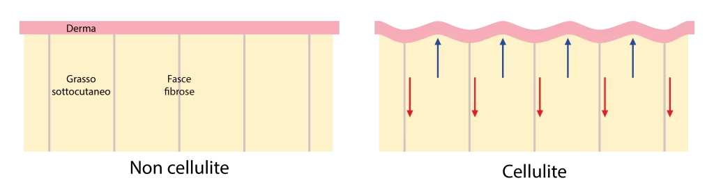 schema pelle con cellulite